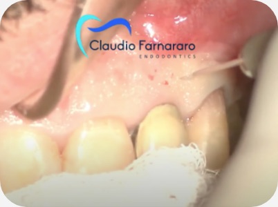 Claudio Farnararo Endodonzia | Endodonzia chirurgica