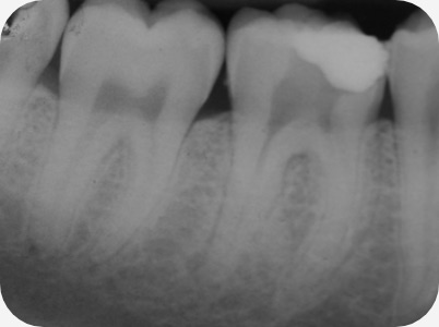 Claudio Farnararo Endodonzia | Anatomie complesse