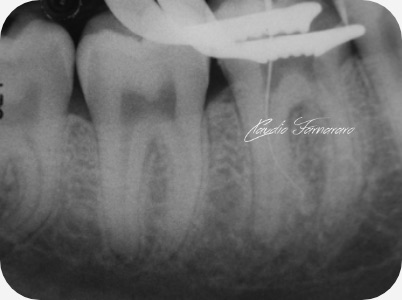 Claudio Farnararo Endodonzia | Anatomie complesse