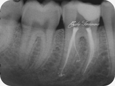 Claudio Farnararo Endodonzia | Anatomie complesse