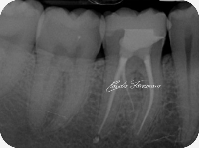 Claudio Farnararo Endodonzia | Anatomie complesse