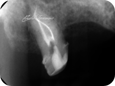 Claudio Farnararo Endodonzia | Anatomie complesse