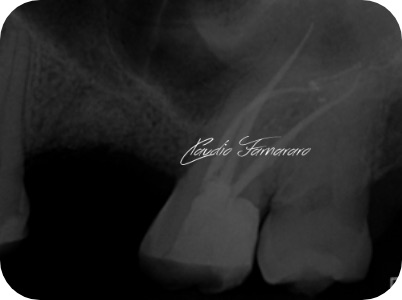 Claudio Farnararo Endodonzia | Anatomie complesse