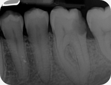 Claudio Farnararo Endodonzia | Anatomie complesse