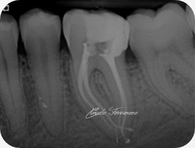 Claudio Farnararo Endodonzia | Anatomie complesse