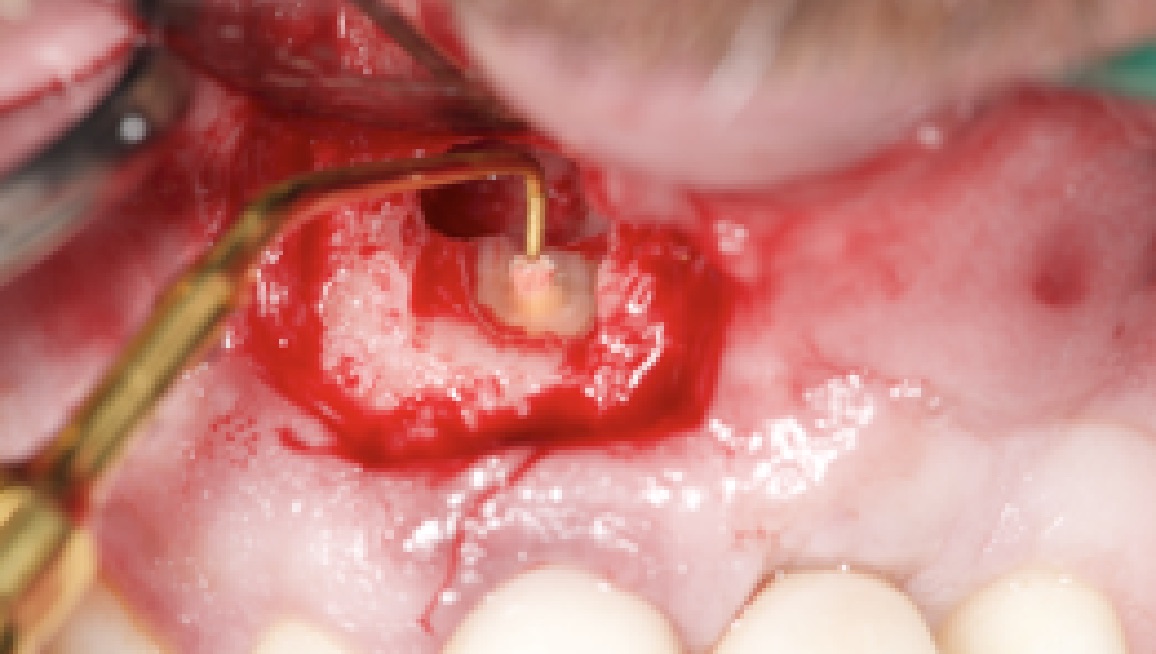Claudio Farnararo Endodonzia | Endodonzia chirurgica