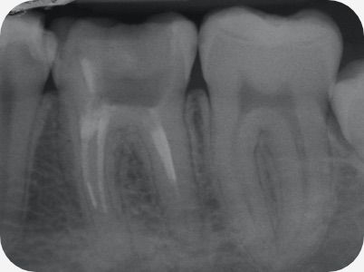 Claudio Farnararo Endodonzia | Caso Ritrattamenti
