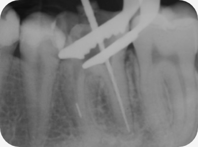Claudio Farnararo Endodonzia | Caso Ritrattamenti