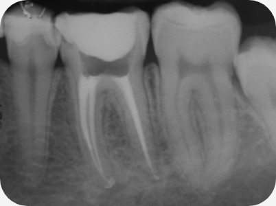Claudio Farnararo Endodonzia | Caso Ritrattamenti