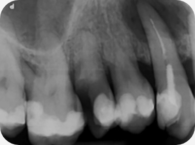Claudio Farnararo Endodonzia | Caso Ritrattamenti