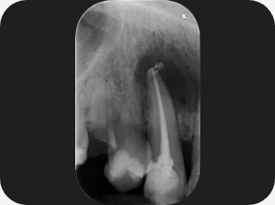 Claudio Farnararo Endodonzia | Caso Ritrattamenti