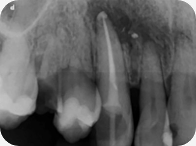 Claudio Farnararo Endodonzia | Caso Ritrattamenti