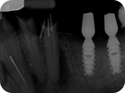Claudio Farnararo Endodonzia | Ritrattamenti