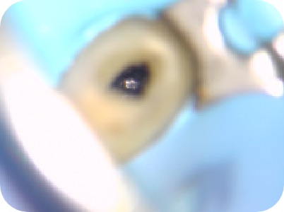 Claudio Farnararo Endodonzia | Ritrattamenti