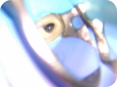 Claudio Farnararo Endodonzia | Ritrattamenti