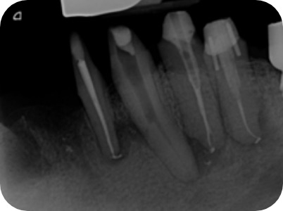 Claudio Farnararo Endodonzia | Ritrattamenti