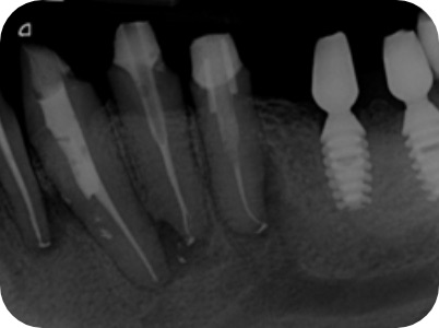 Claudio Farnararo Endodonzia | Ritrattamenti