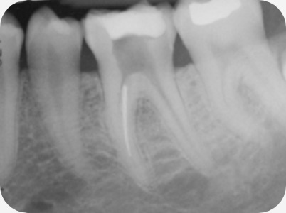 Claudio Farnararo Endodonzia | Caso Ritrattamenti