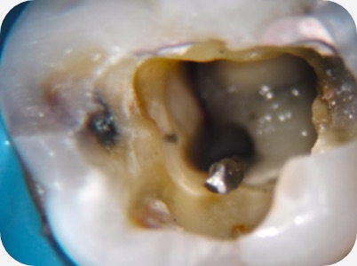 Claudio Farnararo Endodonzia | Caso Ritrattamenti