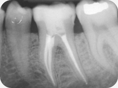 Claudio Farnararo Endodonzia | Caso Ritrattamenti