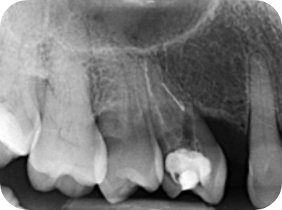 Claudio Farnararo Endodonzia | Ritrattamenti