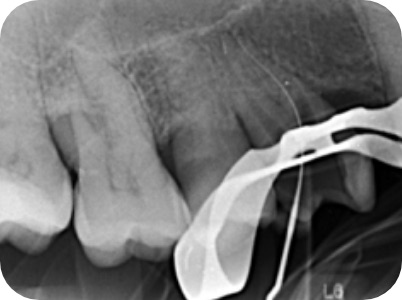 Claudio Farnararo Endodonzia | Ritrattamenti