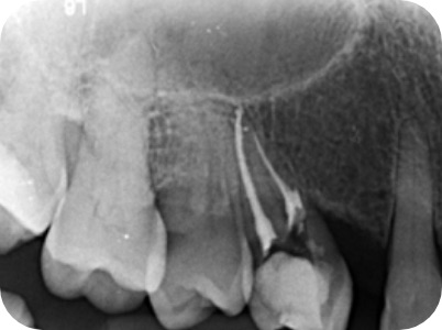 Claudio Farnararo Endodonzia | Ritrattamenti