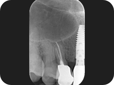 Claudio Farnararo Endodonzia | Ritrattamenti