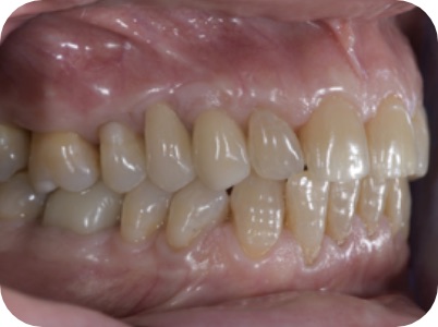 Claudio Farnararo Endodonzia | Ritrattamenti