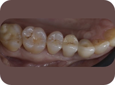 Claudio Farnararo Endodonzia | Ritrattamenti