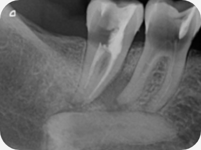 Claudio Farnararo Endodonzia | Caso Ritrattamenti