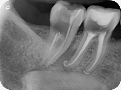 Claudio Farnararo Endodonzia | Caso Ritrattamenti