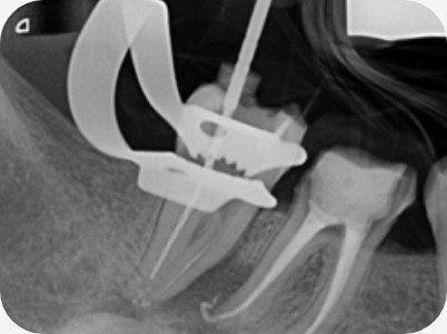 Claudio Farnararo Endodonzia | Caso Ritrattamenti