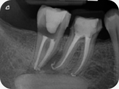 Claudio Farnararo Endodonzia | Caso Ritrattamenti