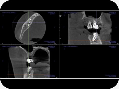 Claudio Farnararo Endodonzia | Caso Ritrattamenti