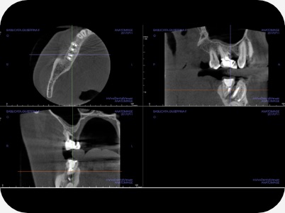 Claudio Farnararo Endodonzia | Caso Ritrattamenti