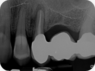 Claudio Farnararo Endodonzia | Caso Trauma