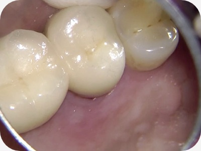 Claudio Farnararo Endodonzia | Caso Trauma