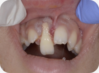 Claudio Farnararo Endodonzia | Caso Trauma