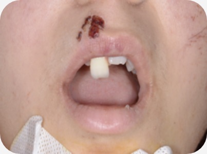 Claudio Farnararo Endodonzia | Caso Trauma