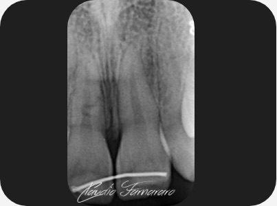 Claudio Farnararo Endodonzia | Caso Trauma
